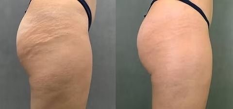 Side-by-side close-up of a person’s hip and thigh showing skin dimpling before and after treatment