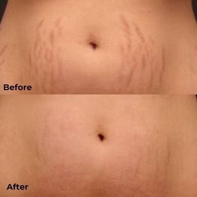 Split image showing a stomach with stretch marks before and after treatment, smoother in the after photo