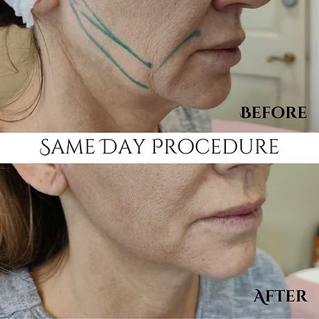 Before-and-after side profile of a woman’s jawline with marked treatment lines; same day procedure.