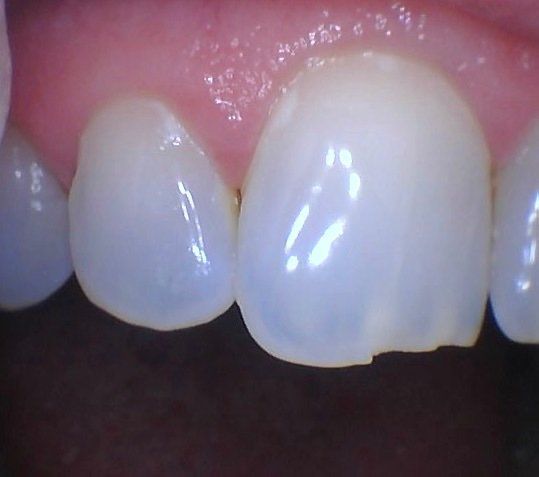 Before tooth filling