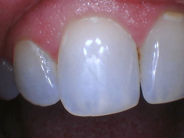 After tooth filling