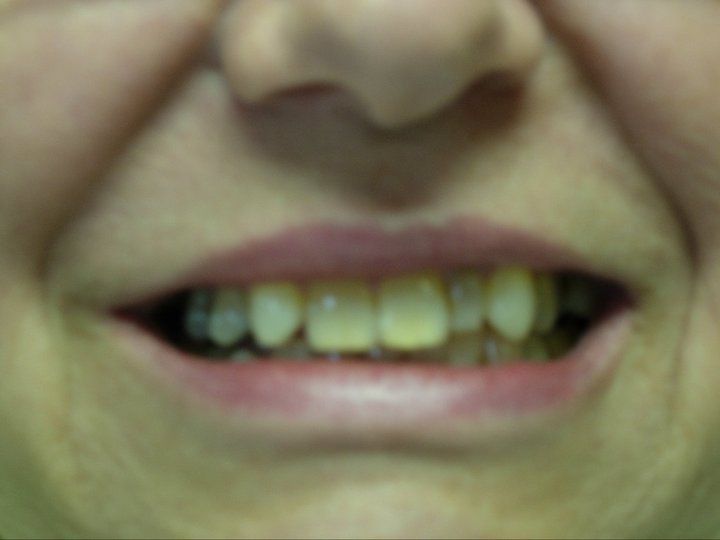 Before photo of dental makeover - missing lateral incisor, different colored teeth