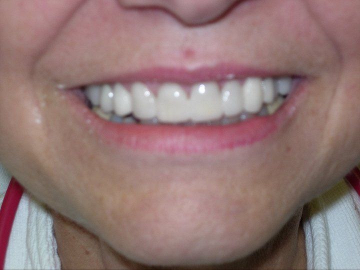 After photo of dental makeover