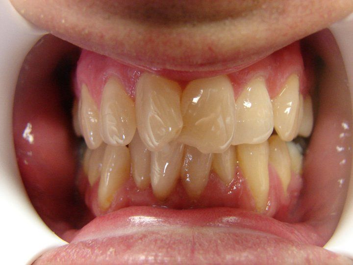 Before photo of severe crowding