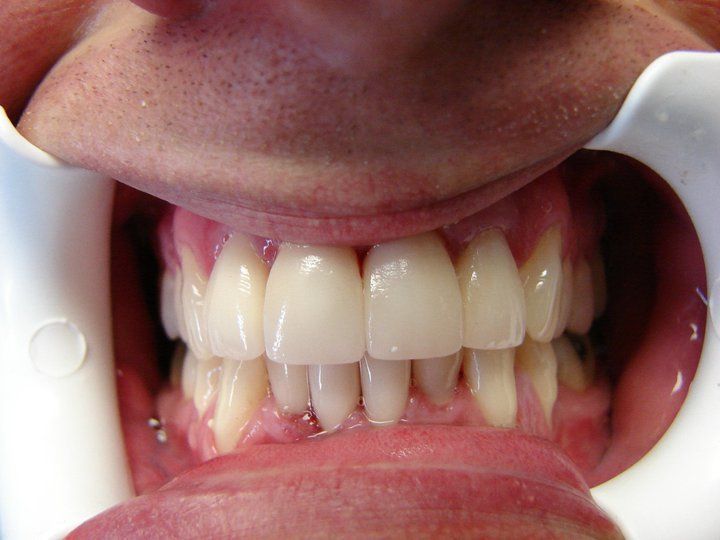 After photo of severe crowding relieved by crowns