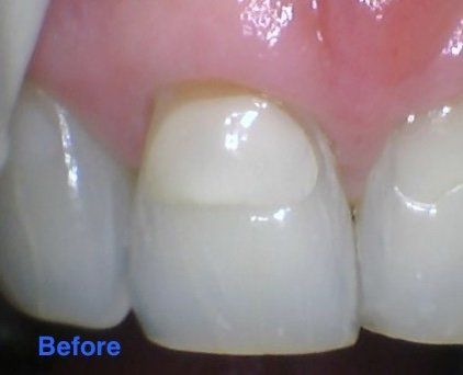 Discolored filling - before