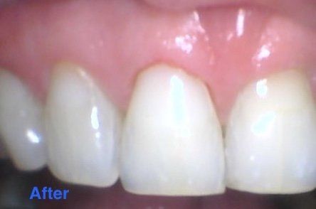 Discolored filling - after