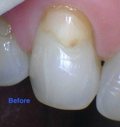Discolored tooth filling - before