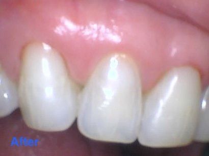 Discolored tooth filling - after