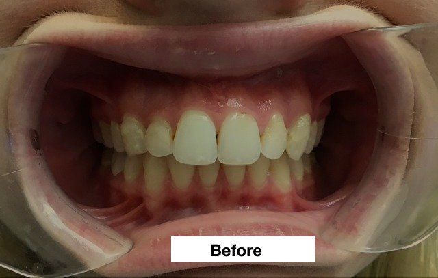 Discolored tooth fillings - before