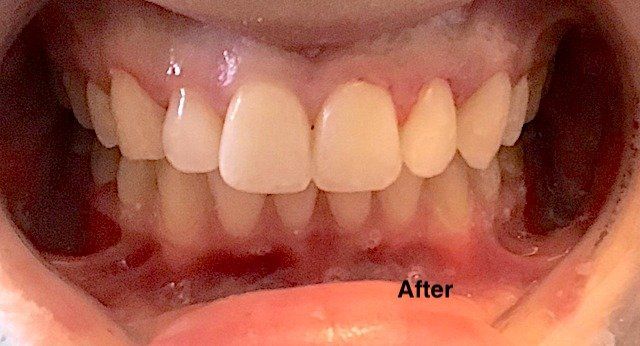 Discolored tooth fillings - after