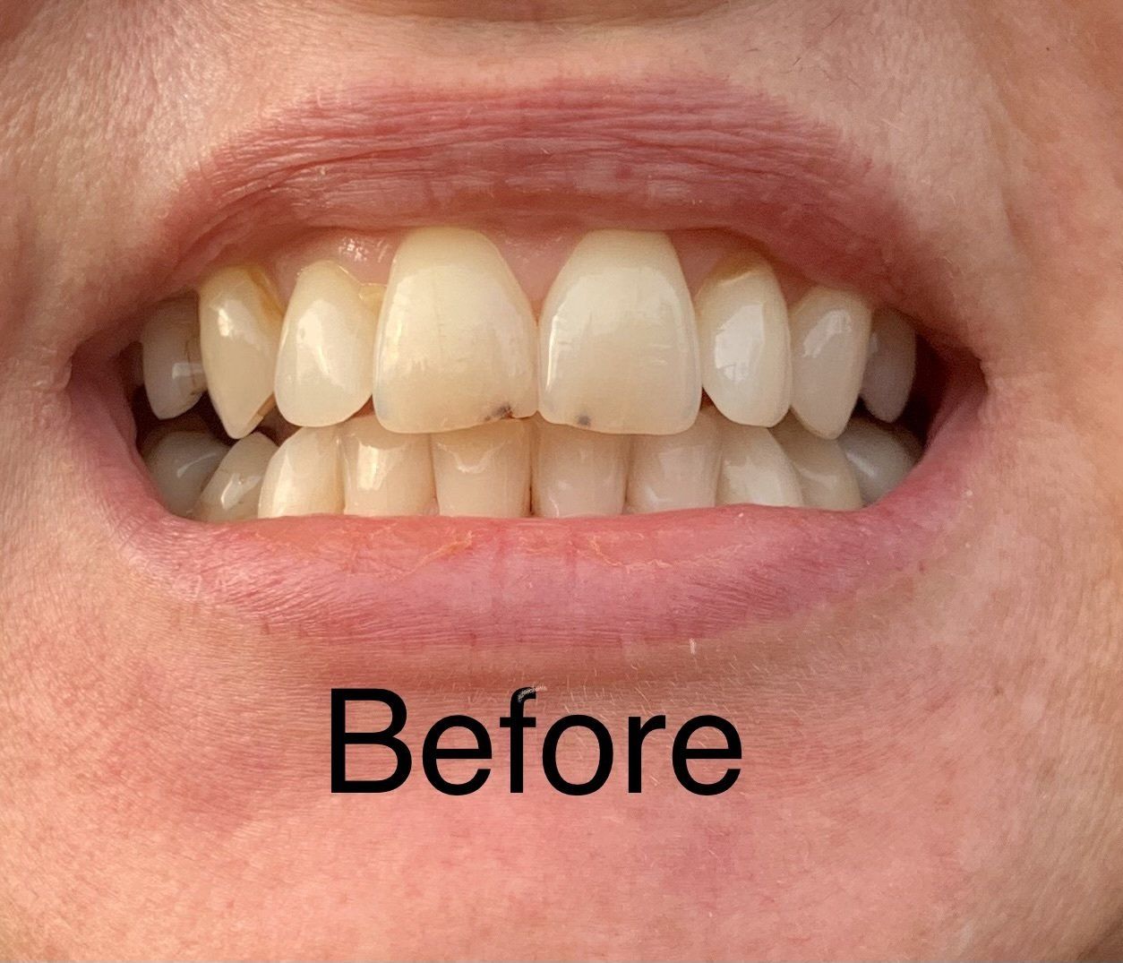 Fixed discolored fillings and teeth - before