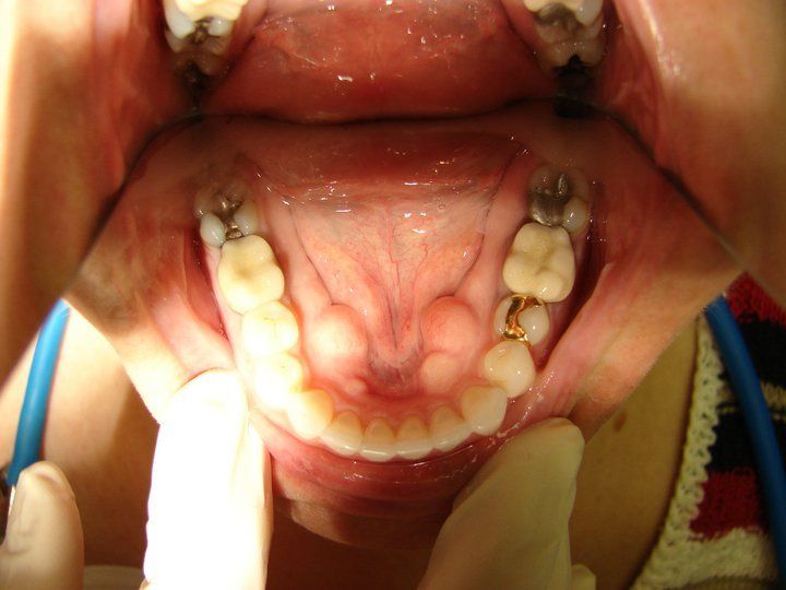 Invisalign - after photo