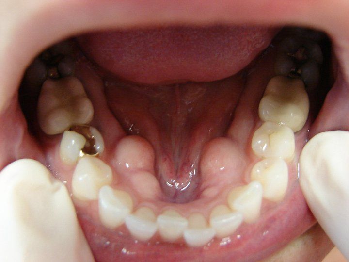 Invisalign - before photo