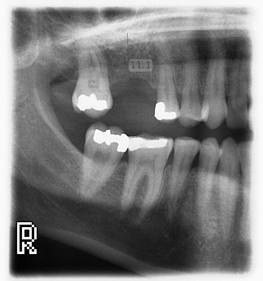 Implant - before