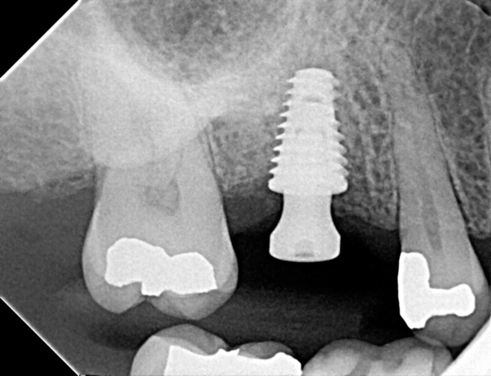 Implant - after