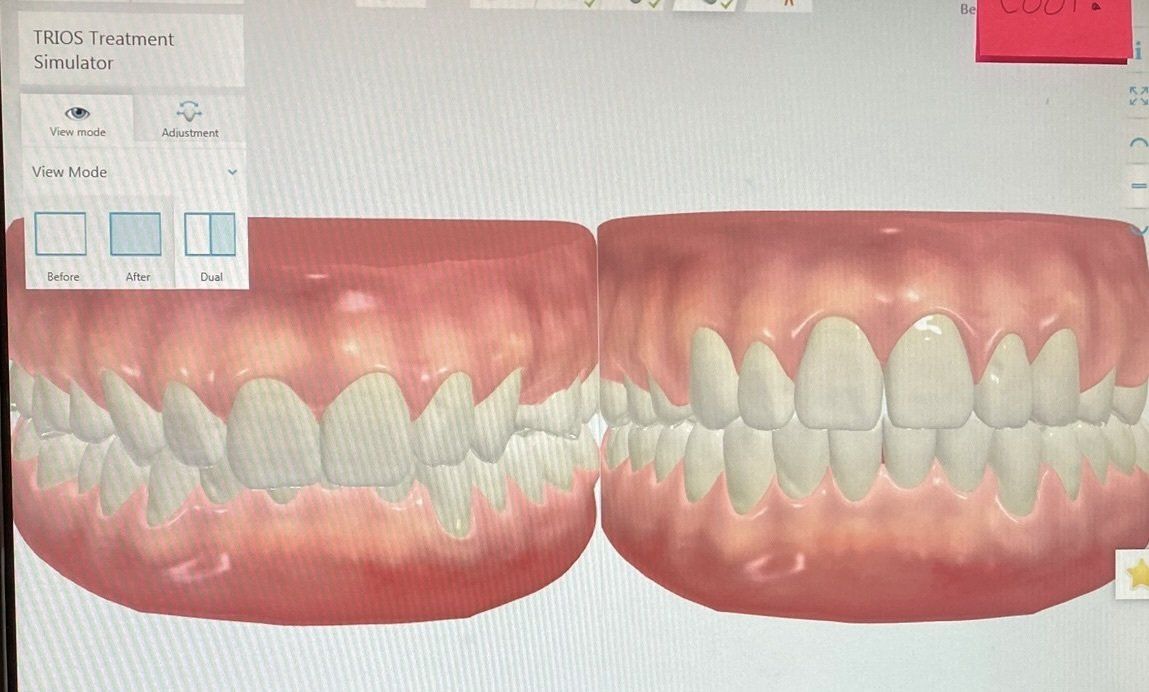 Immediate preview Clear Braces