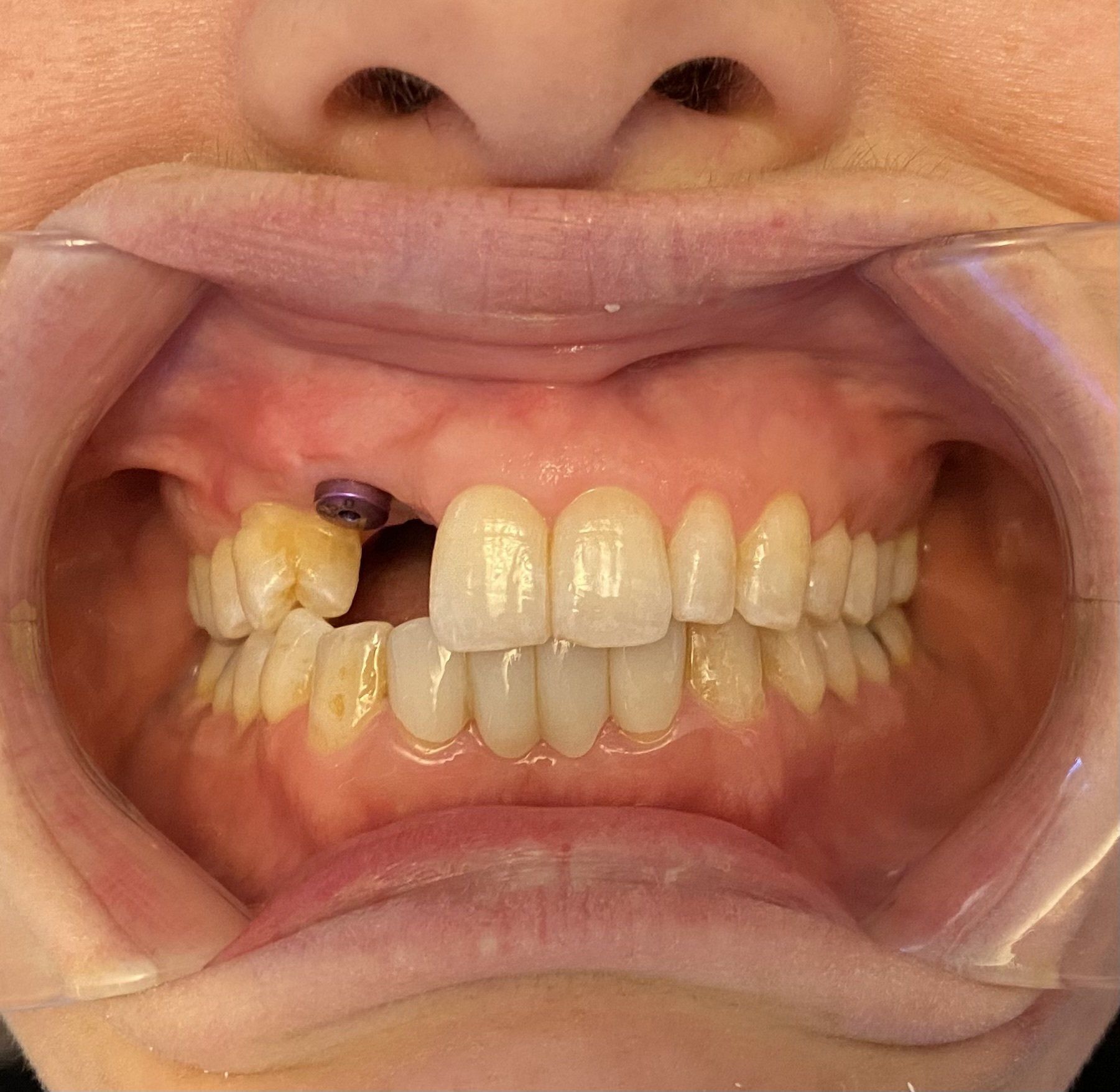 Missing tooth - before