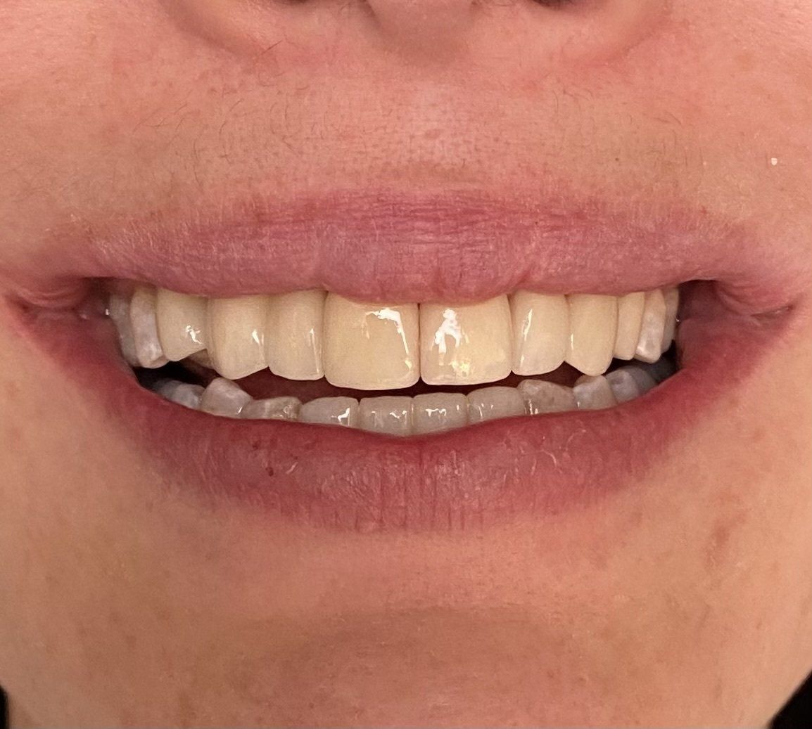 Fixed missing tooth - after