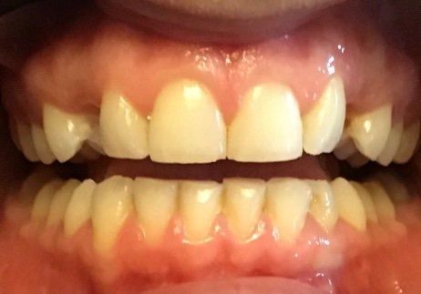 Patient born without canine teeth - before