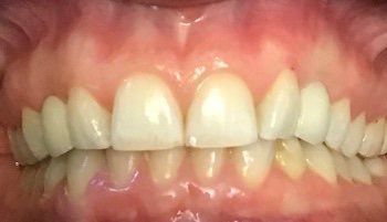 Patient born without canine teeth - after