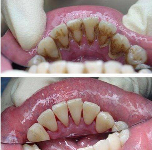 Dental cleaning - before and after