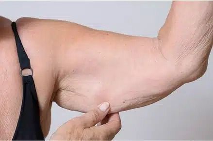 Hand pinching upper arm to show loose skin under a black bra strap