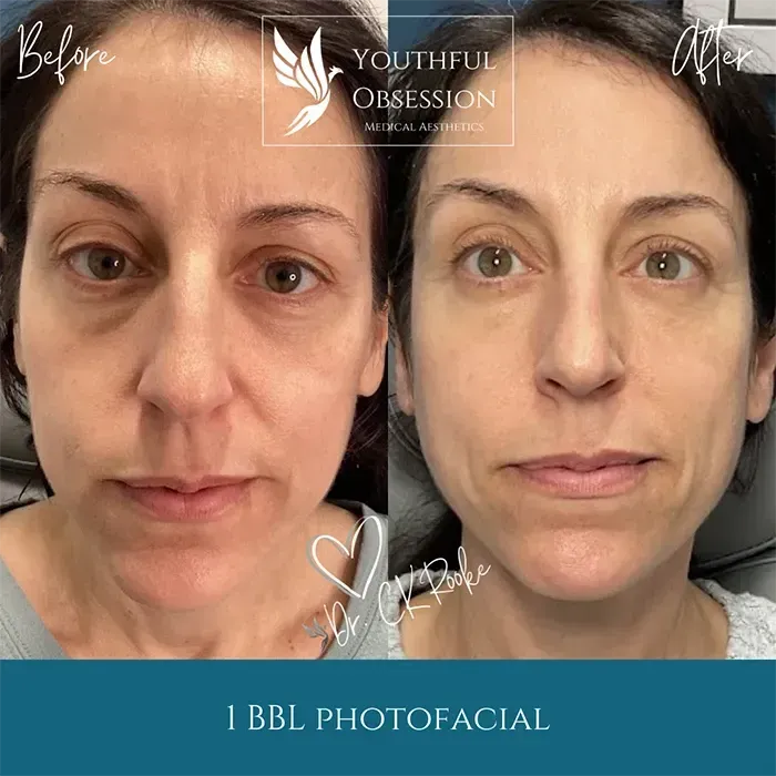 Before-and-after facial treatment comparison, showing smoother, brighter skin on the right.