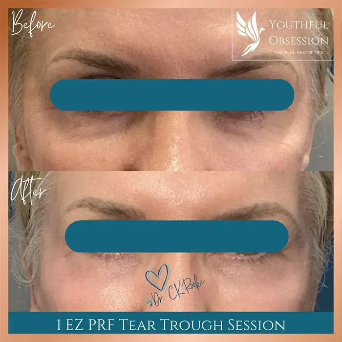 Before-and-after close-up of a face showing under-eye tear trough treatment results, with labels and teal bars obscuring eyes
