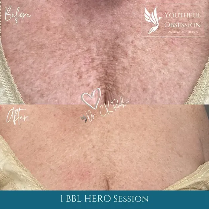 Upper chest with visible redness before a BBL Hero session, labeled “Before” and “After” with clinic branding.