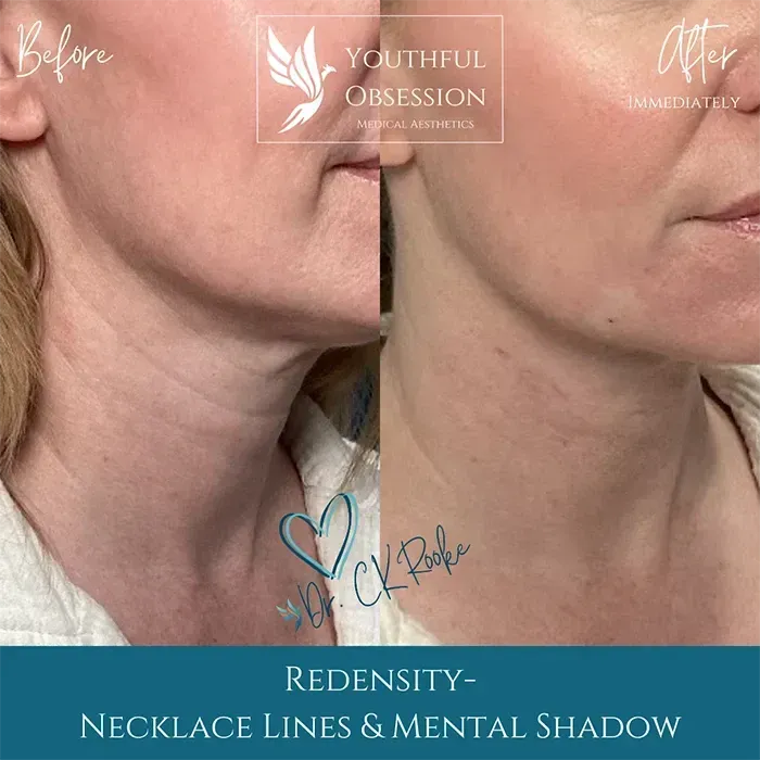 Before-and-after close-up of neck skin with “Youthful Obsession” logo and “Redensity” caption over teal band.