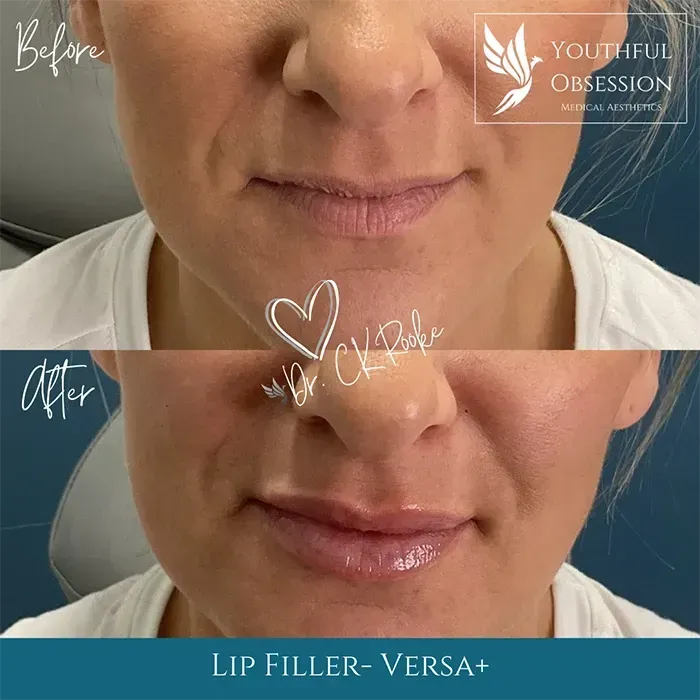 Before-and-after close-up of lips and chin showing lip filler results, with “Before” and “After” labels.