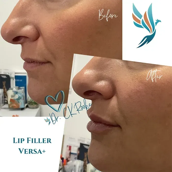 Before-and-after side profile of nose and lip filler results, with clinic branding and “LIP FILLER VERSA+” text.