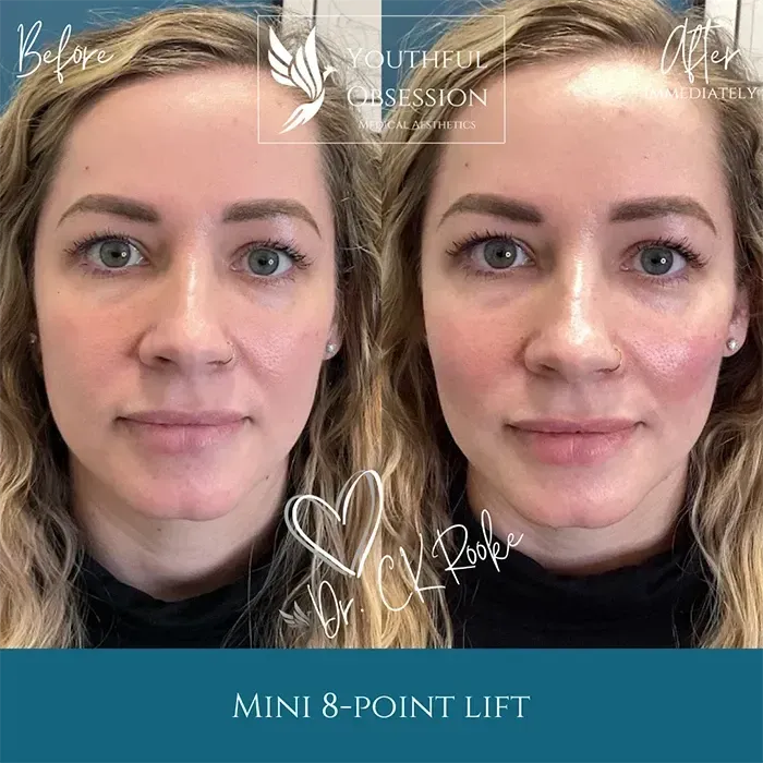 Side-by-side portrait of a woman before and after a mini 8-point facial lift, with subtle smile on the right.