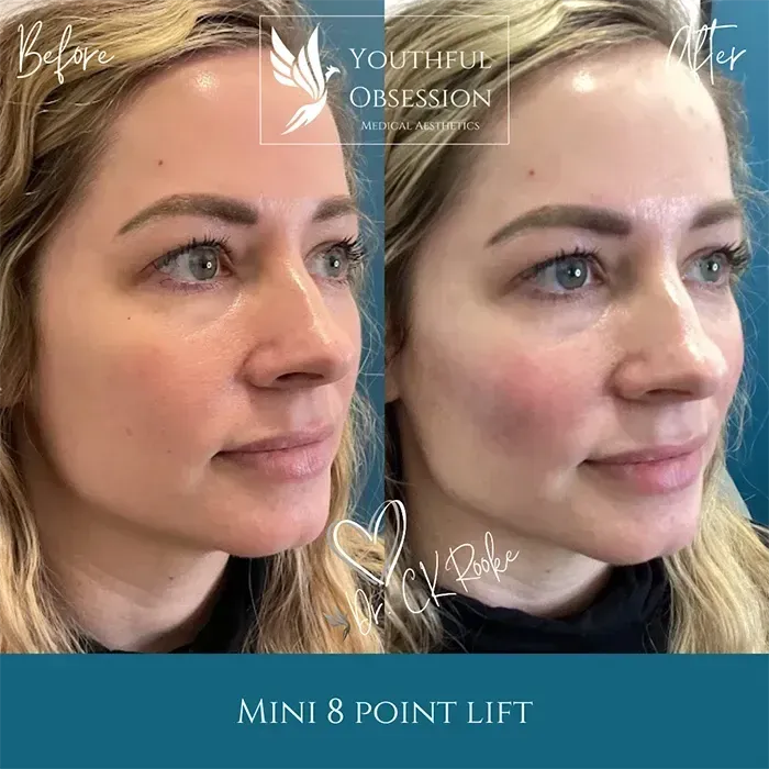 Side-by-side close-up facial comparison labeled “Mini 8 Point Lift,” before and after result.