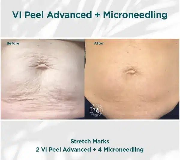 Before-and-after abdomen photos showing reduced stretch marks after VI Peel Advanced and microneedling