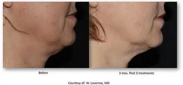 Side-by-side profile photos of a chin/neck before and after treatment, showing reduced fullness.