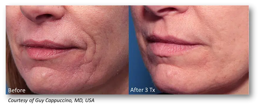 Side-by-side close-up of lower face before and after treatment, showing reduced chin wrinkles.