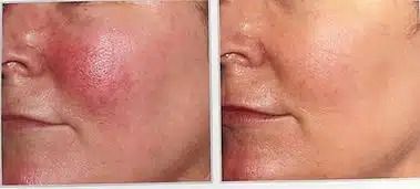 Before-and-after close-up of a swollen red cheek beside a healed, normal-looking cheek.
