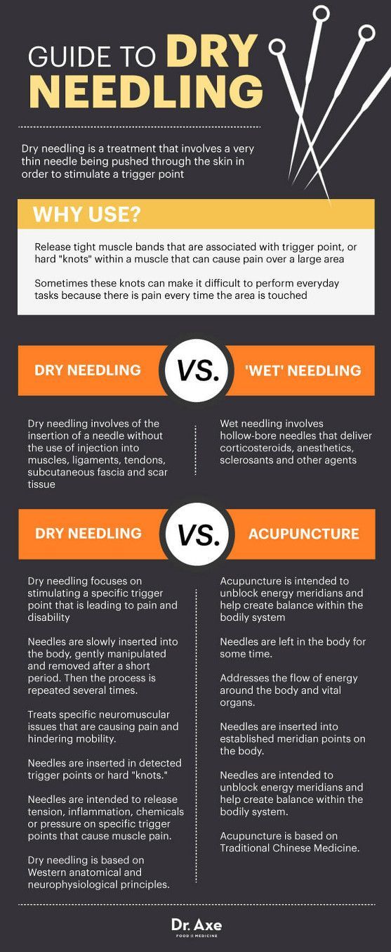 Guide to dry needling