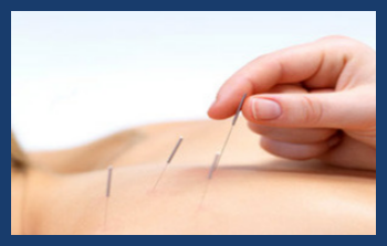 Dry needling