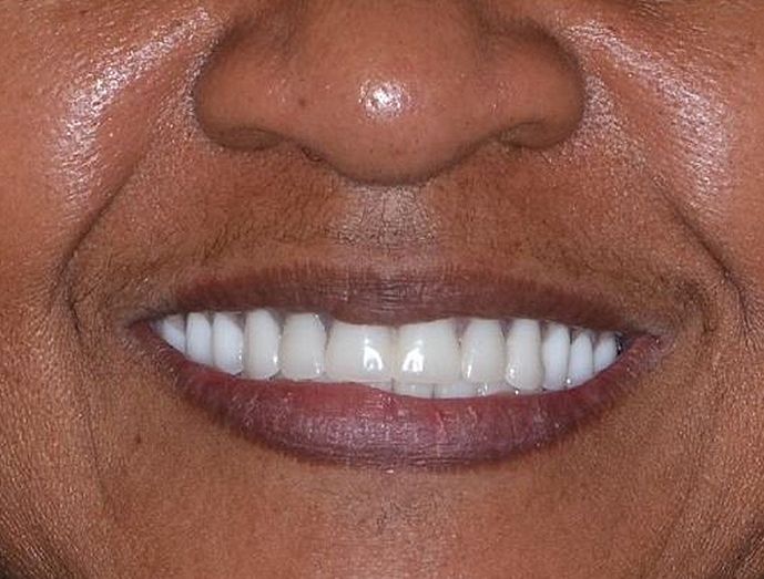 dental implants after image
