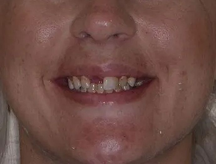 dental implants before image