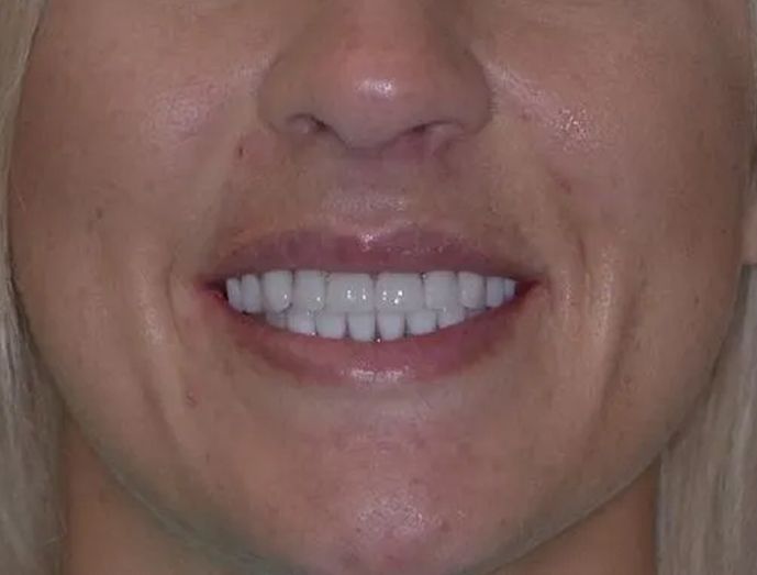 dental implants after image