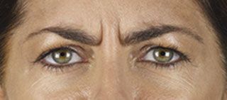 A person's eyes and brow area with a furrowed expression showing vertical lines between the eyebrows.