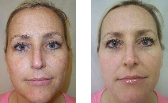 Before and after comparison showing a decrease in facial skin pigmentation and improved skin tone.