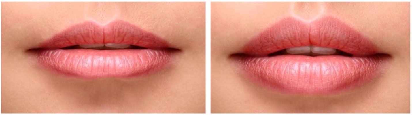 A split screen showing lips before and after a cosmetic enhancement procedure.