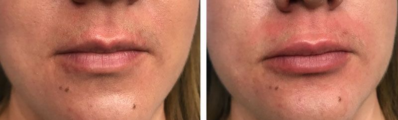 A comparison showing a person’s lips before and after a cosmetic filler procedure.