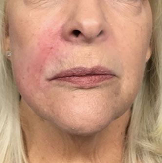 A close-up of a person's lower face showing a patch of redness on the right cheek extending from the nose to the mouth.