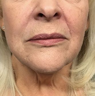 Close-up view of the lower half of a face, showing skin texture, lip shape, and natural wrinkles around the mouth.